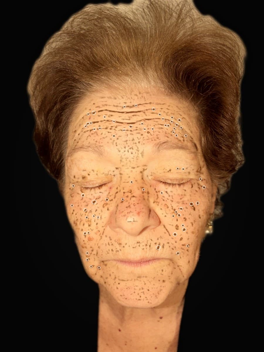 Filtro Pigmentazione