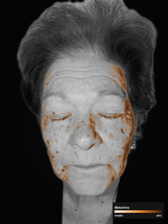 Mappa Melanina sul volto demo