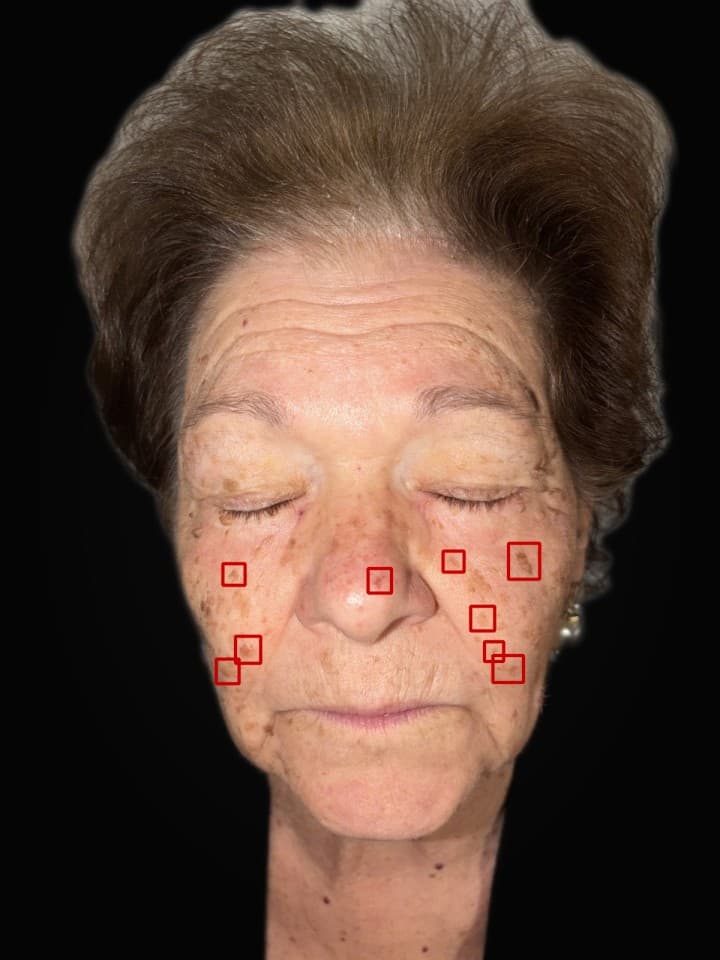 Rilevatore Acne sul volto demo